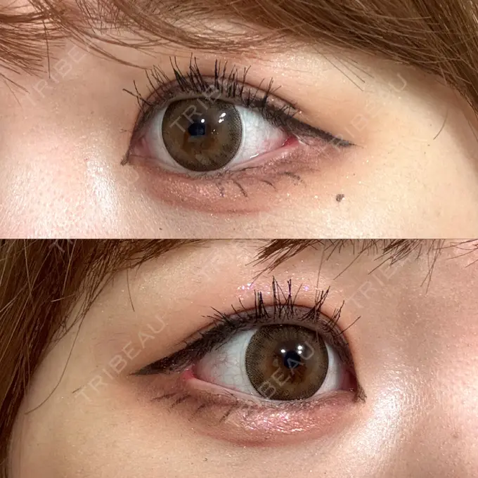 目尻切開 / 目尻靭帯移動 GLANZ CLINIC AFTER メイン用