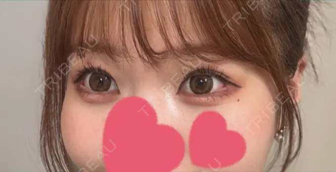 目尻切開 / 目尻靭帯移動 GLANZ CLINIC DAY 43 メイン用