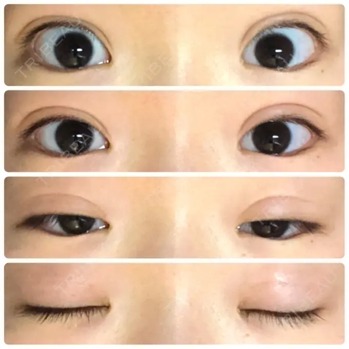 二重埋没 湘南美容クリニック 新宿本院 DAY 14 メイン用