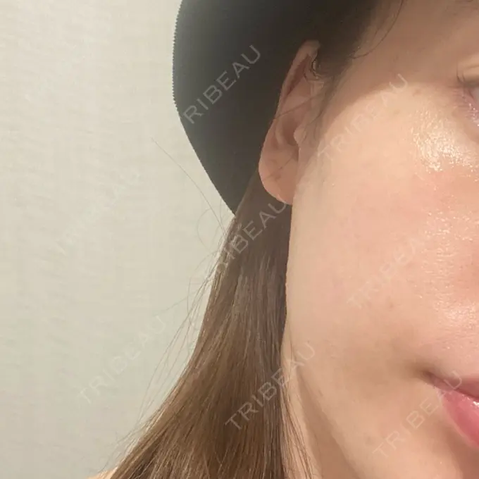 ピーリング（ニキビ・毛穴） 新宿美容外科クリニック 新宿院 AFTER メイン用