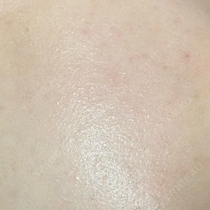 ピーリング（ニキビ・毛穴） 新宿美容外科クリニック 新宿院 DAY 2 メイン用