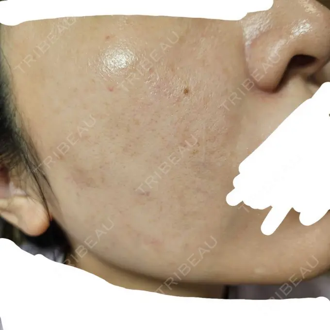 水光注射（ハリ・美肌） オラクル美容皮膚科 名古屋院 DAY 6 メイン用