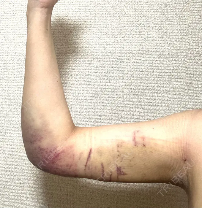 脂肪吸引（二の腕） アムルーズ美容外科クリニック 横浜院 DAY 2 メイン用
