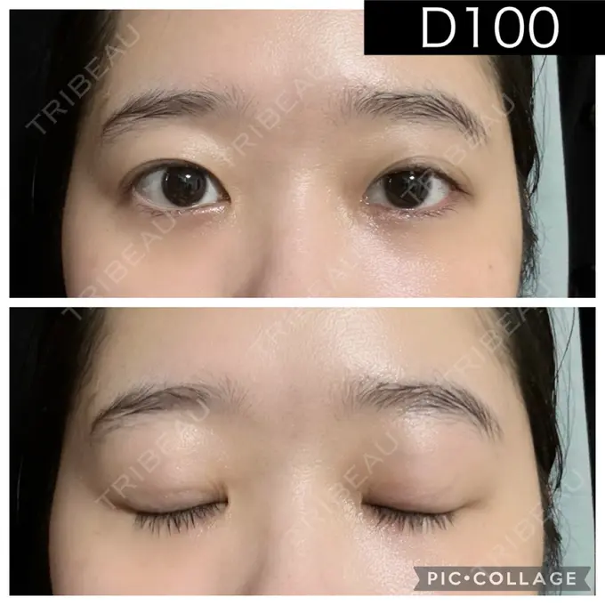 二重埋没 湘南美容クリニック 町田院 DAY 100 メイン用