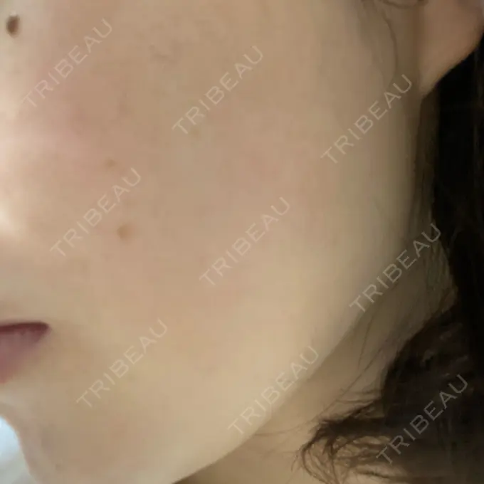 ピーリング（ニキビ・毛穴） / ルメッカ ルラ美容クリニック 広島院 AFTER メイン用