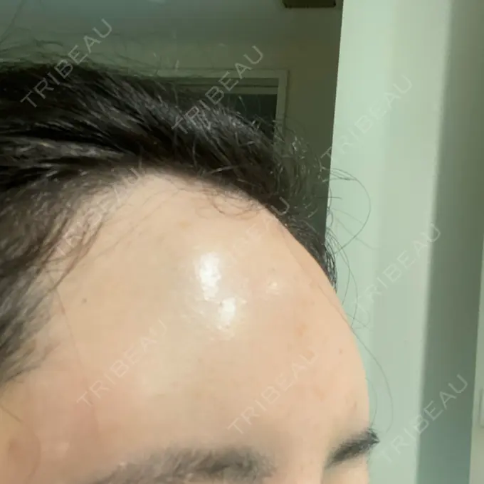 ヒアルロン酸注入（額） / ヒアルロン酸注入（頬） / ヒアルロン酸注入（こめかみ） / ボトックス（眉間） LA CLEF CLINIC（ラクレクリニック） DAY 9 メイン用