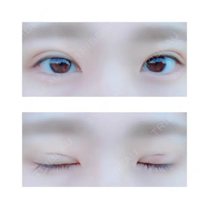 二重切開 有楽町高野美容クリニック DAY 6 メイン用