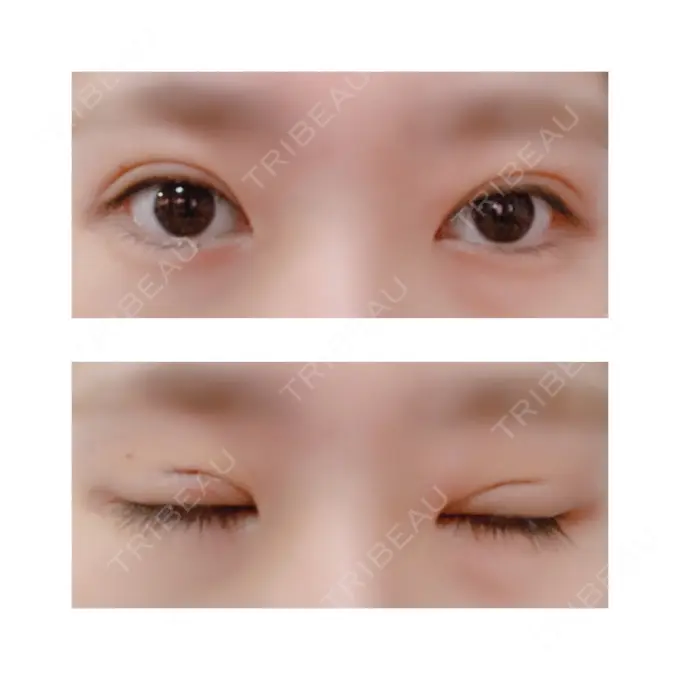 二重切開 有楽町高野美容クリニック DAY 7 メイン用