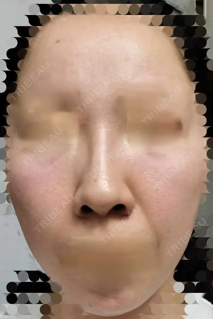 ルメッカ ルラ美容クリニック 神戸院 DAY 7 メイン用