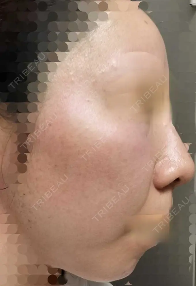 ルメッカ ルラ美容クリニック 神戸院 DAY 7 メイン用