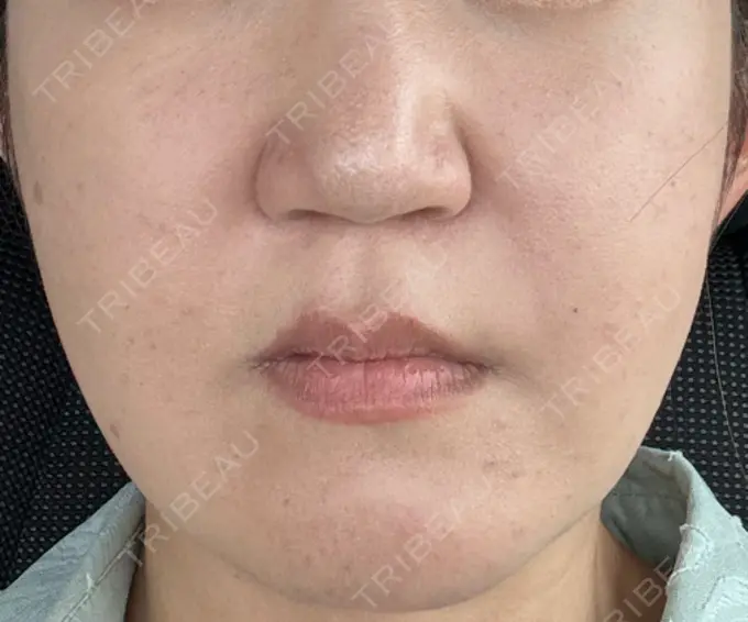 脂肪吸引（顔） スノウ（Snow）整形外科 DAY 14 メイン用