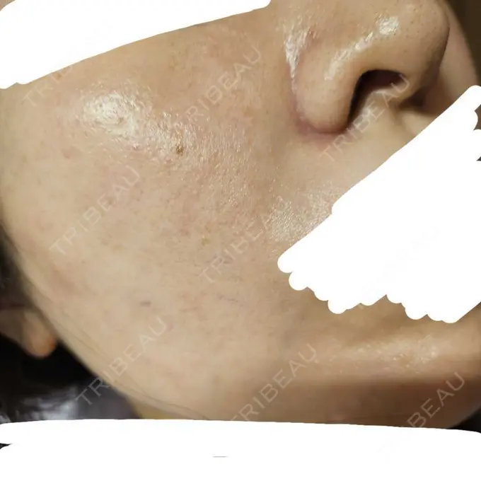 水光注射（ハリ・美肌） オラクル美容皮膚科 名古屋院 AFTER メイン用