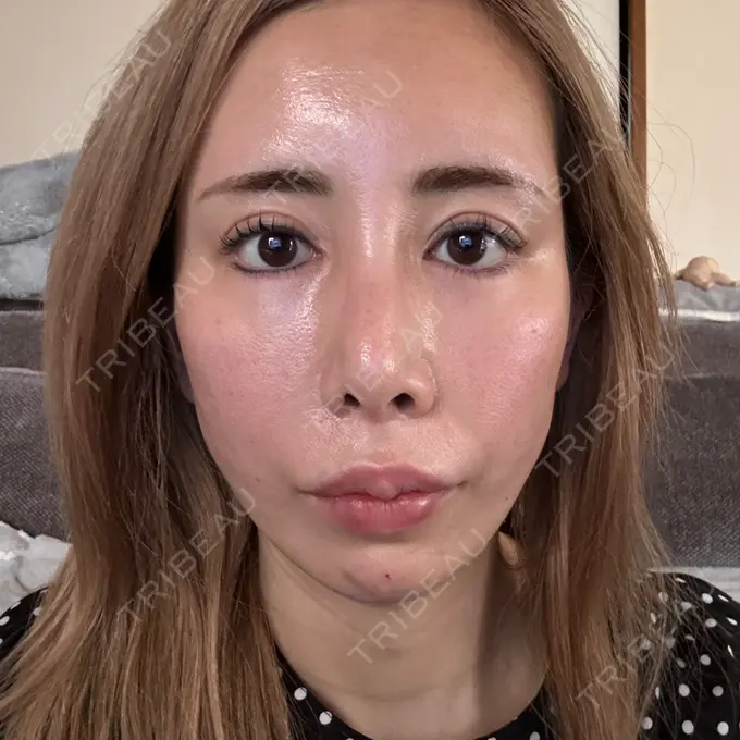 糸リフト / 脂肪吸引（顔） / ヒアルロン酸注入（あご） THE FIRST CLINIC 多摩センター院 DAY 0 メイン用