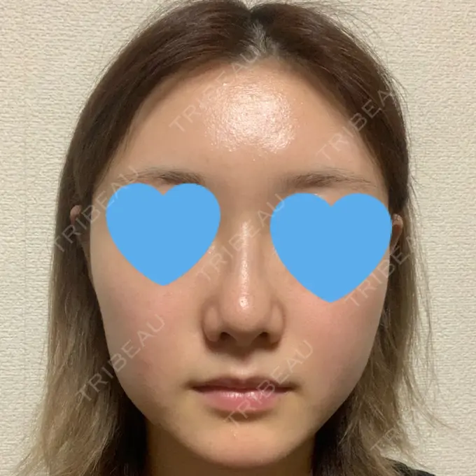 鼻中隔延長（非切開） TCB東京中央美容外科 八王子院 DAY 9 メイン用