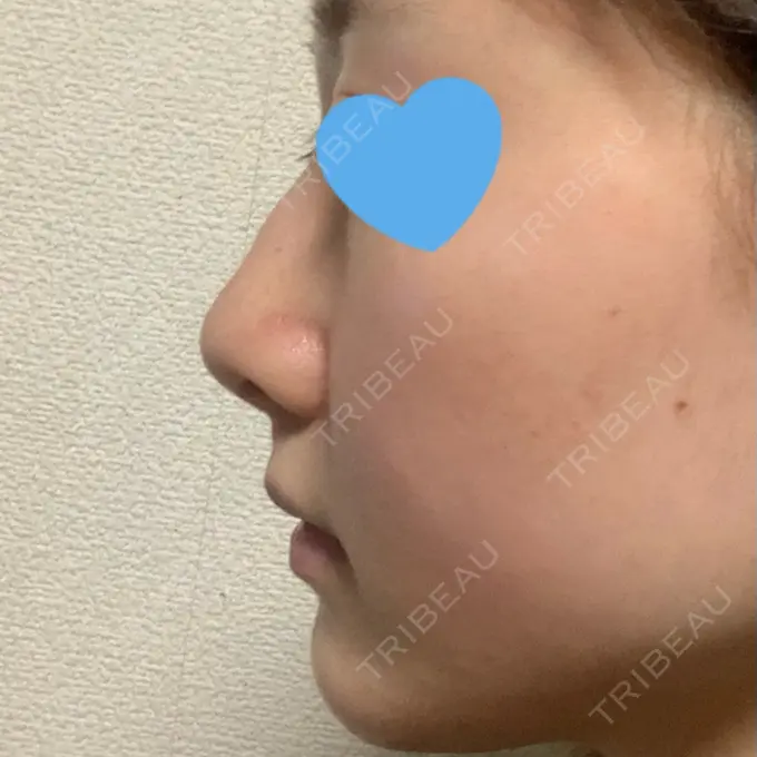 鼻中隔延長（非切開） TCB東京中央美容外科 八王子院 DAY 9 メイン用