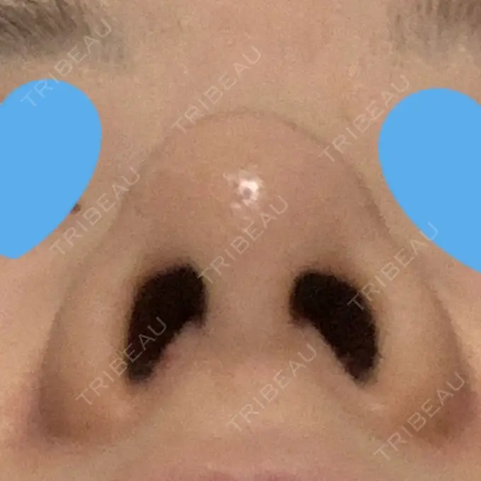 鼻中隔延長（非切開） TCB東京中央美容外科 八王子院 DAY 9 メイン用