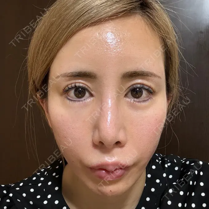 糸リフト / 脂肪吸引（顔） / ヒアルロン酸注入（あご） THE FIRST CLINIC 多摩センター院 DAY 0 メイン用