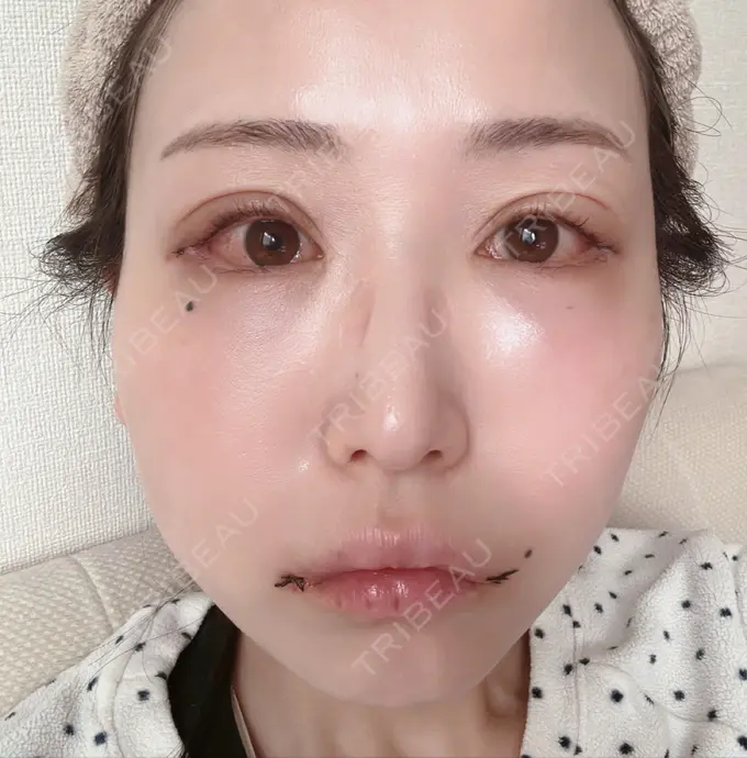 目尻靭帯移動 アネシス美容クリニック DAY 3 メイン用