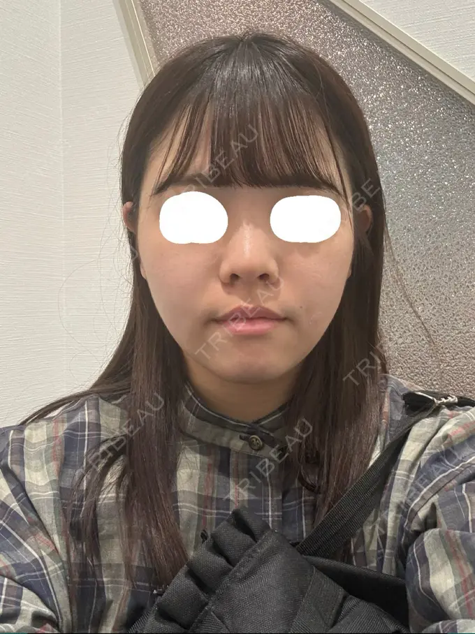 脂肪吸引（顔） / メーラーファット除去 / ボトックス（エラ・小顔） Rosa Beauty Clinic AFTER メイン用