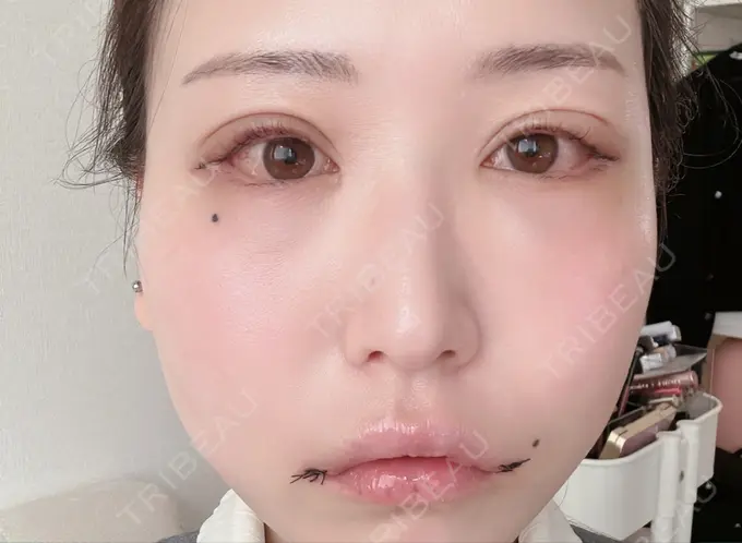 目尻靭帯移動 アネシス美容クリニック DAY 4 メイン用