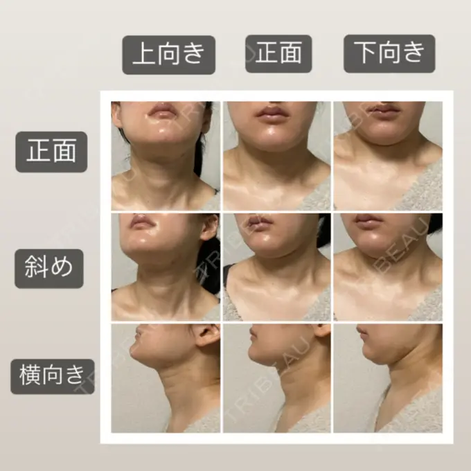 脂肪吸引（顔） 湘南美容クリニック 秋葉原院 DAY 28 メイン用