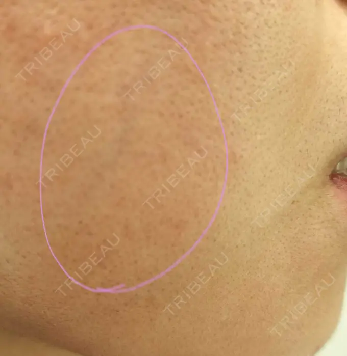 ルメッカ ルラ美容クリニック 神戸院 DAY 9 メイン用