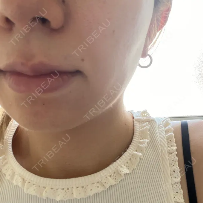 ピーリング（ニキビ・毛穴） 新宿美容外科クリニック 新宿院 AFTER メイン用