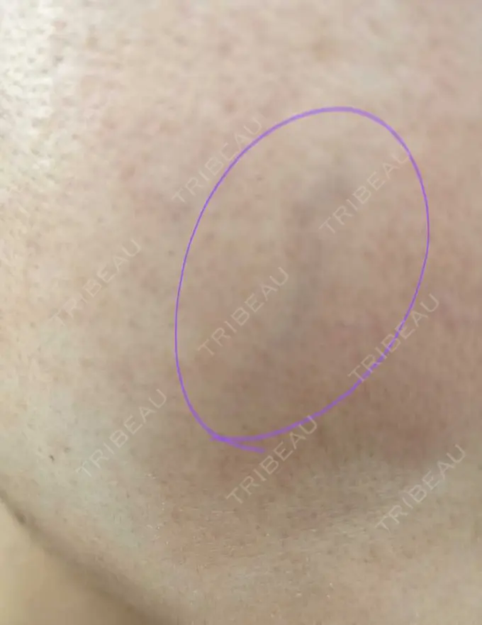 ルメッカ ルラ美容クリニック 神戸院 DAY 8 メイン用