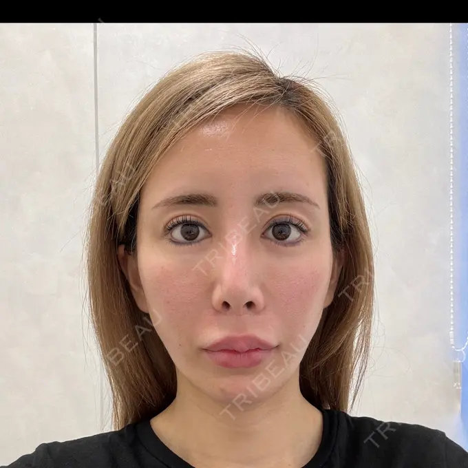 糸リフト / 脂肪吸引（顔） / ヒアルロン酸注入（あご） THE FIRST CLINIC 多摩センター院 DAY 2 メイン用