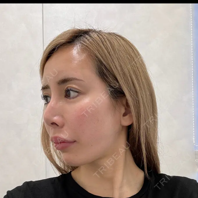 糸リフト / 脂肪吸引（顔） / ヒアルロン酸注入（あご） THE FIRST CLINIC 多摩センター院 DAY 2 メイン用