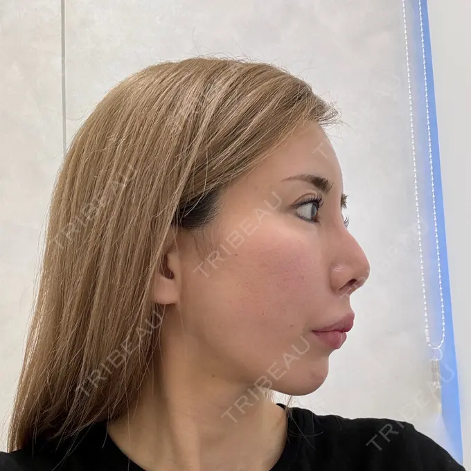 糸リフト / 脂肪吸引（顔） / ヒアルロン酸注入（あご） THE FIRST CLINIC 多摩センター院 DAY 2 メイン用