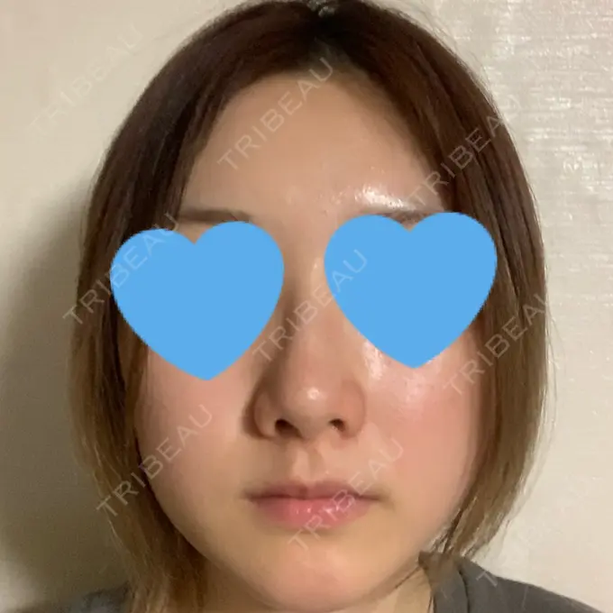 鼻中隔延長（非切開） TCB東京中央美容外科 八王子院 DAY 11 メイン用