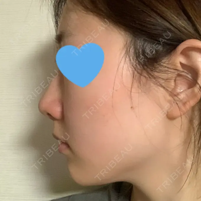 鼻中隔延長（非切開） TCB東京中央美容外科 八王子院 DAY 11 メイン用