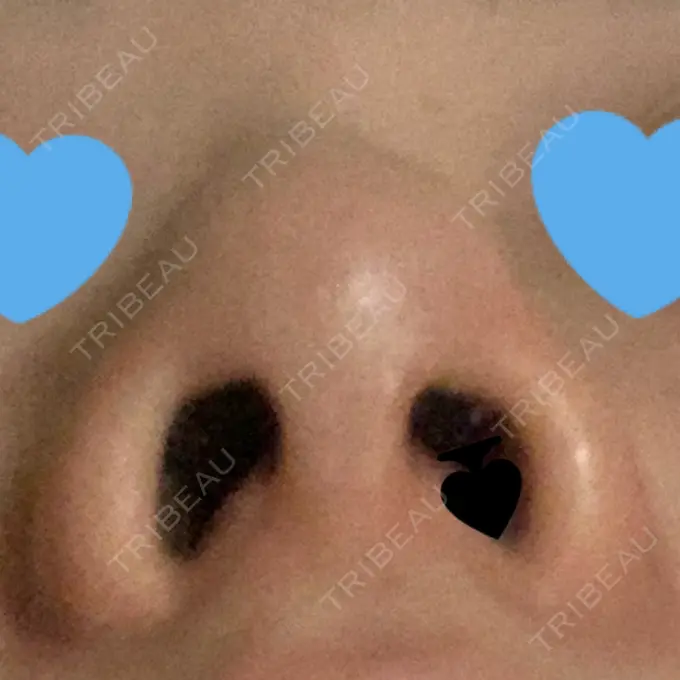 鼻中隔延長（非切開） TCB東京中央美容外科 八王子院 DAY 11 メイン用