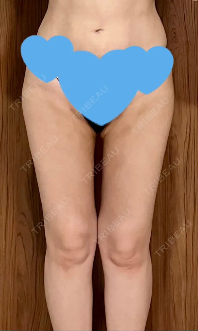 脂肪吸引（顔） / 脂肪吸引（脚） / 脂肪吸引（お尻） Mods Clinic（モッズクリニック） 福岡院 DAY 93 メイン用