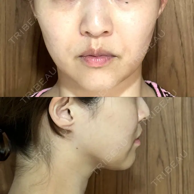 脂肪吸引（顔） / 脂肪吸引（脚） / 脂肪吸引（お尻） Mods Clinic（モッズクリニック） 福岡院 DAY 93 メイン用