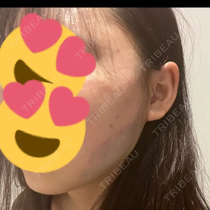 糸リフト / バッカルファット除去 / 脂肪吸引（顔） / ボトックス（エラ・小顔） RIVER CLINIC（リバークリニック） DAY 0 メイン用