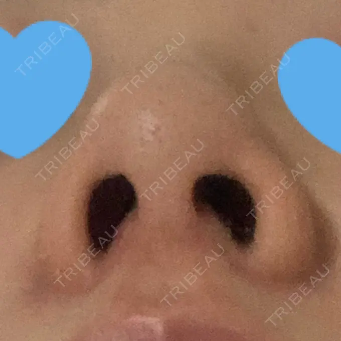 鼻中隔延長（非切開） TCB東京中央美容外科 八王子院 DAY 12 メイン用