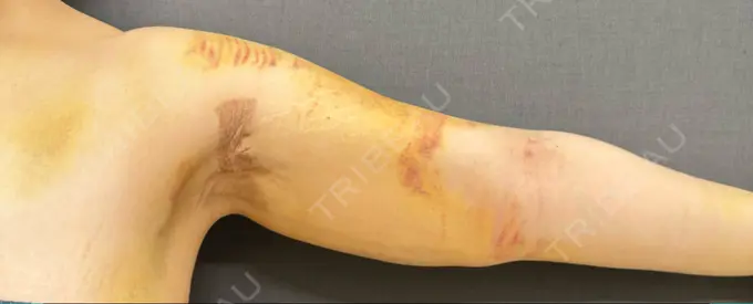 脂肪吸引（二の腕） ルーチェクリニック 銀座院 DAY 7 メイン用