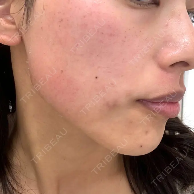 イオン導入 / ルメッカ ルラ美容クリニック 名古屋栄院 / ルラスキンクリニック 名古屋栄院 DAY 0 メイン用