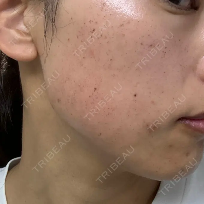 イオン導入 / ルメッカ ルラ美容クリニック 名古屋栄院 / ルラスキンクリニック 名古屋栄院 DAY 1 メイン用