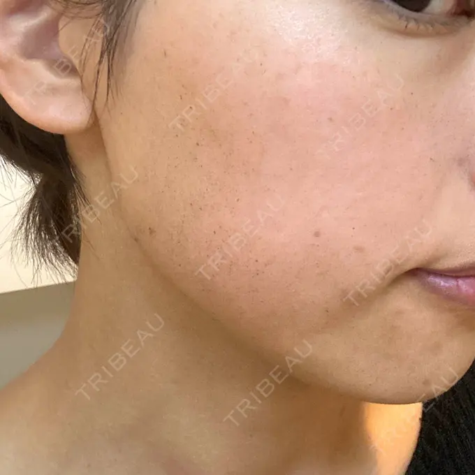 イオン導入 / ルメッカ ルラ美容クリニック 名古屋栄院 / ルラスキンクリニック 名古屋栄院 AFTER メイン用