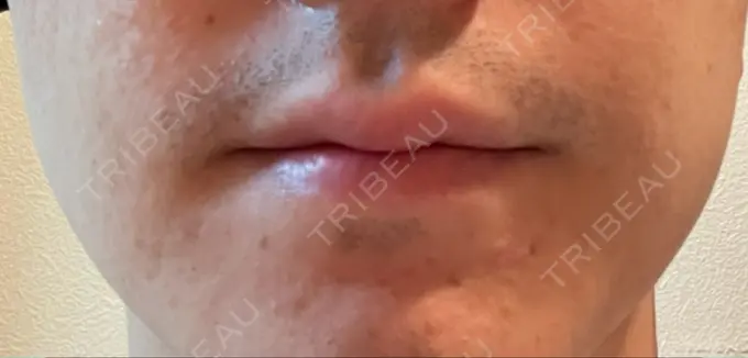 ボトックス（エラ・小顔） TCB東京中央美容外科 新宿三丁目院 AFTER メイン用