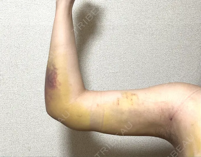 脂肪吸引（二の腕） アムルーズ美容外科クリニック 横浜院 DAY 7 メイン用