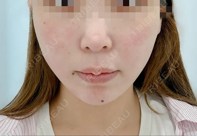 ハイフ（顔） 東京シンデレラ美容外科 大宮院 DAY 0 メイン用