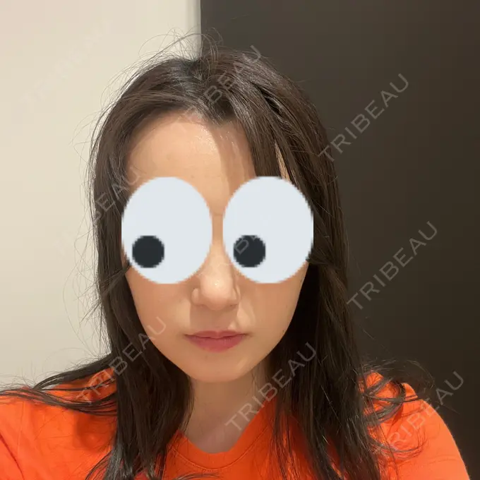 糸リフト / バッカルファット除去 / 脂肪吸引（顔） / ヒアルロン酸注入（鼻） / ボトックス（エラ・小顔） RIVER CLINIC（リバークリニック） AFTER メイン用