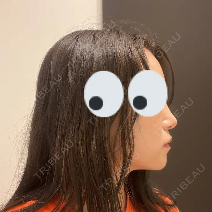 糸リフト / バッカルファット除去 / 脂肪吸引（顔） / ヒアルロン酸注入（鼻） / ボトックス（エラ・小顔） RIVER CLINIC（リバークリニック） DAY 61 メイン用