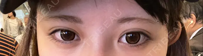 ボトックス（タレ目） 新宿TAクリニック DAY 0 メイン用