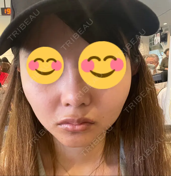 ボトックス（エラ・小顔） ビューティースキンクリニック 渋谷院 DAY 0 メイン用