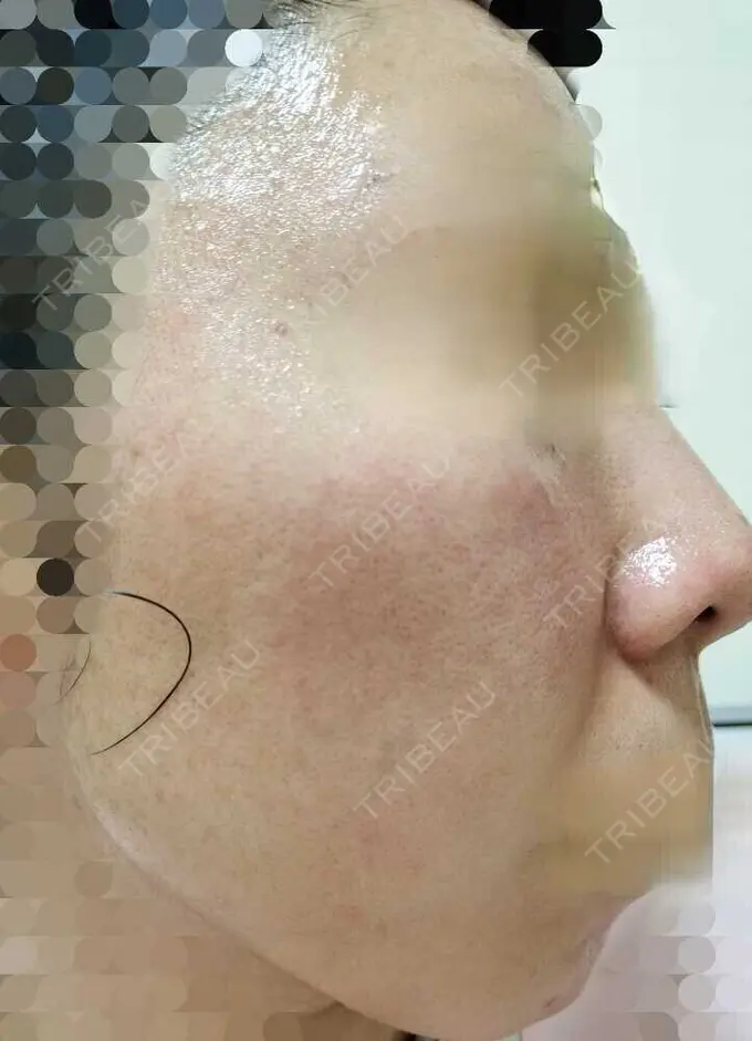 ルメッカ ルラ美容クリニック 神戸院 DAY 11 メイン用